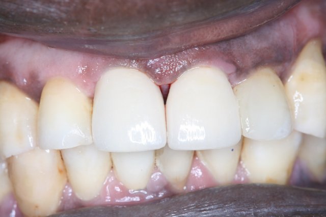 Crowns After